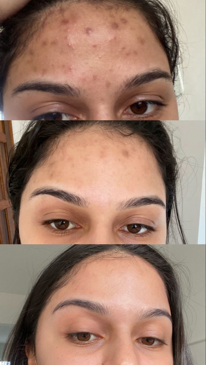 Trị Thâm Mụn Bằng Peel Da Có Hiệu Quả Không?